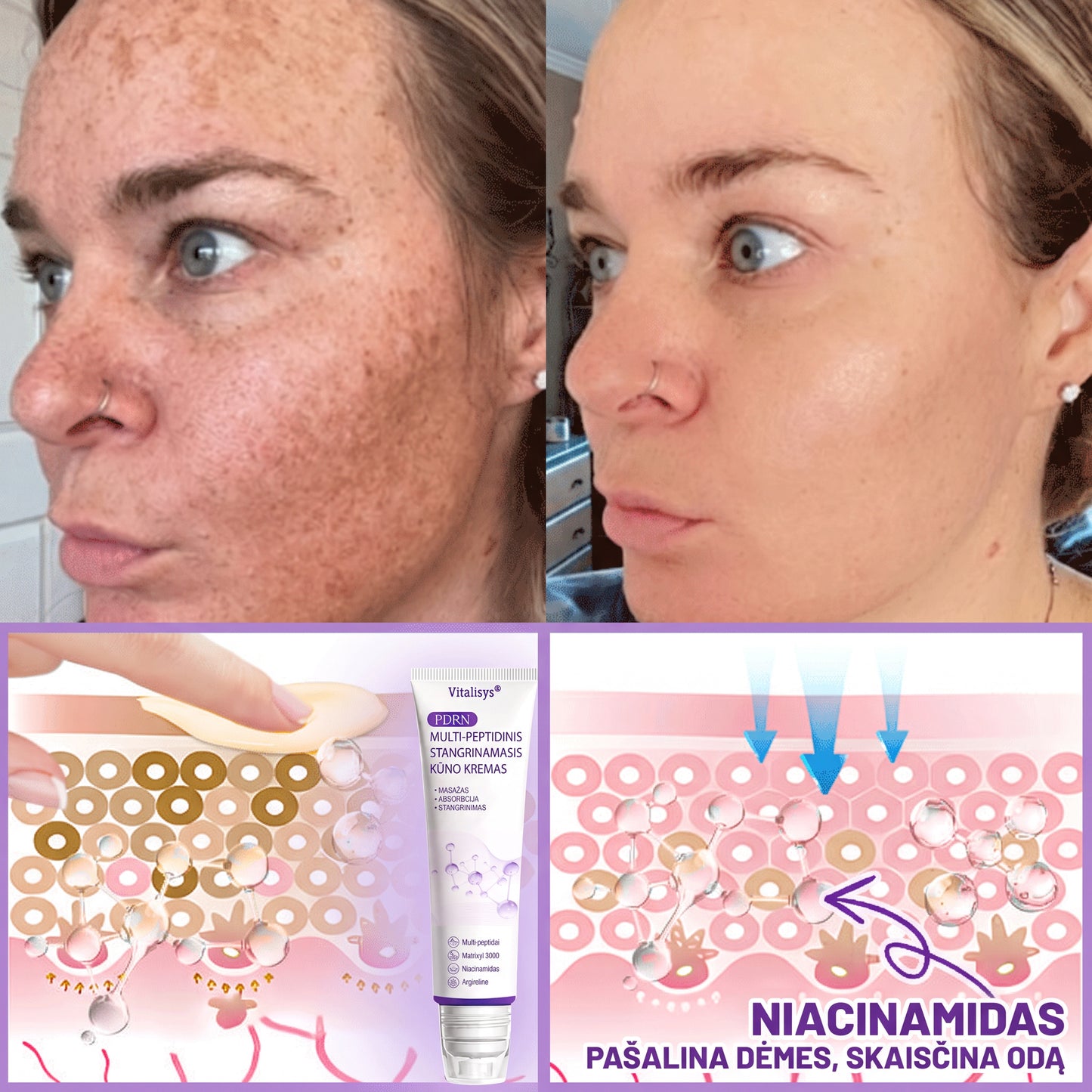 🇱🇹 Dermatologų rekomenduojama🥇 | 🍎Vitalisys® PDRN“daugiapeptidis masažuojamasis kūno kremas – Anti-senėjimo, drėkinamasis,stangrinamasis,odą regeneruojantis,sulyginantis,spuogų ir dėmių šalinimo,karpų ir apgamų šalinimo, psoriazės palengvinimo priemonė.❤️