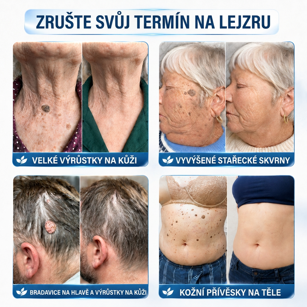 👩‍⚕️💯 Oficiální obchod | MURWON® 🌥️ Mikrojehličková náplast pro odstranění kožních nedokonalostí (Pro kožní výrůstky, drobné kožní útvary, bradavice, mateřská znaménka, stařecké skvrny a pigmentové nepravidelnosti.)❤️