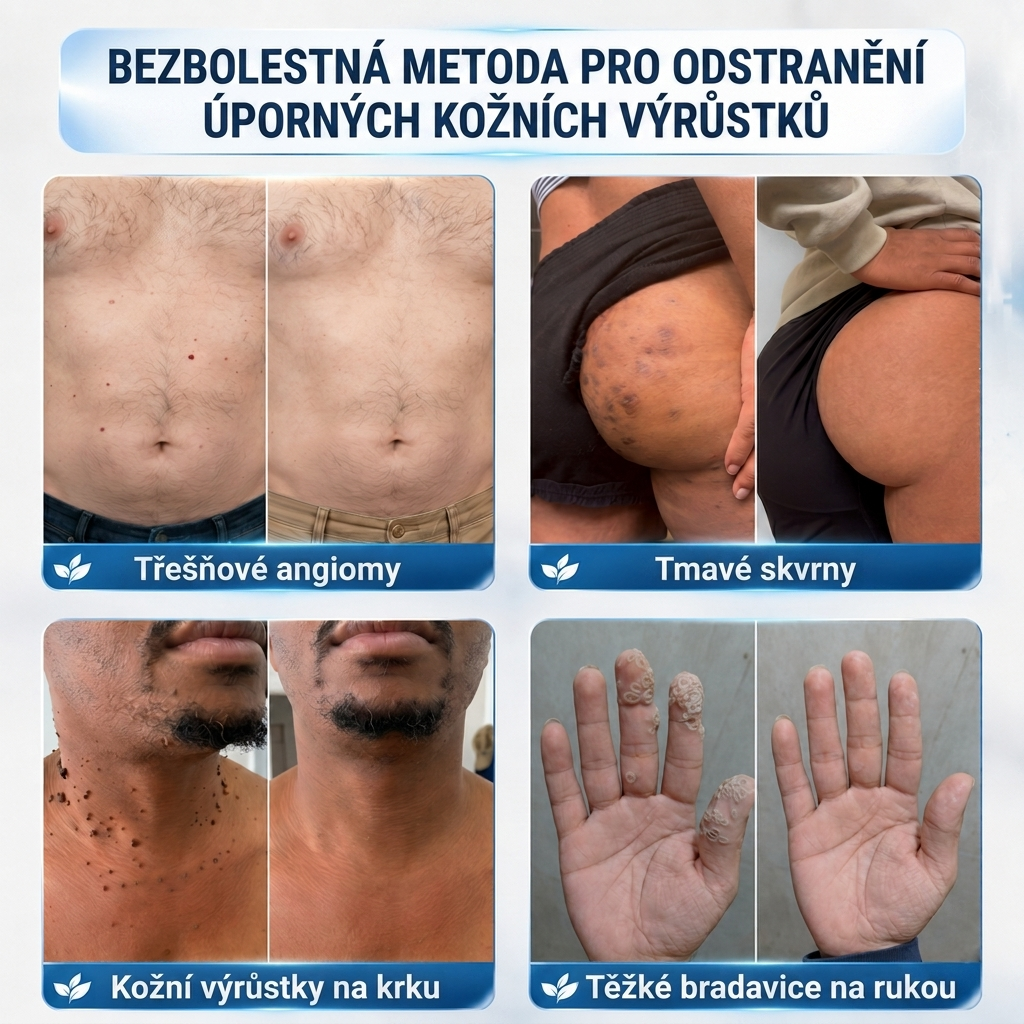 👩‍⚕️💯 Oficiální obchod | MURWON® 🌥️ Mikrojehličková náplast pro odstranění kožních nedokonalostí (Pro kožní výrůstky, drobné kožní útvary, bradavice, mateřská znaménka, stařecké skvrny a pigmentové nepravidelnosti.)❤️