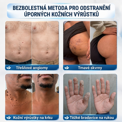 👩‍⚕️💯 Oficiální obchod | MURWON® 🌥️ Mikrojehličková náplast pro odstranění kožních nedokonalostí (Pro kožní výrůstky, drobné kožní útvary, bradavice, mateřská znaménka, stařecké skvrny a pigmentové nepravidelnosti.)❤️