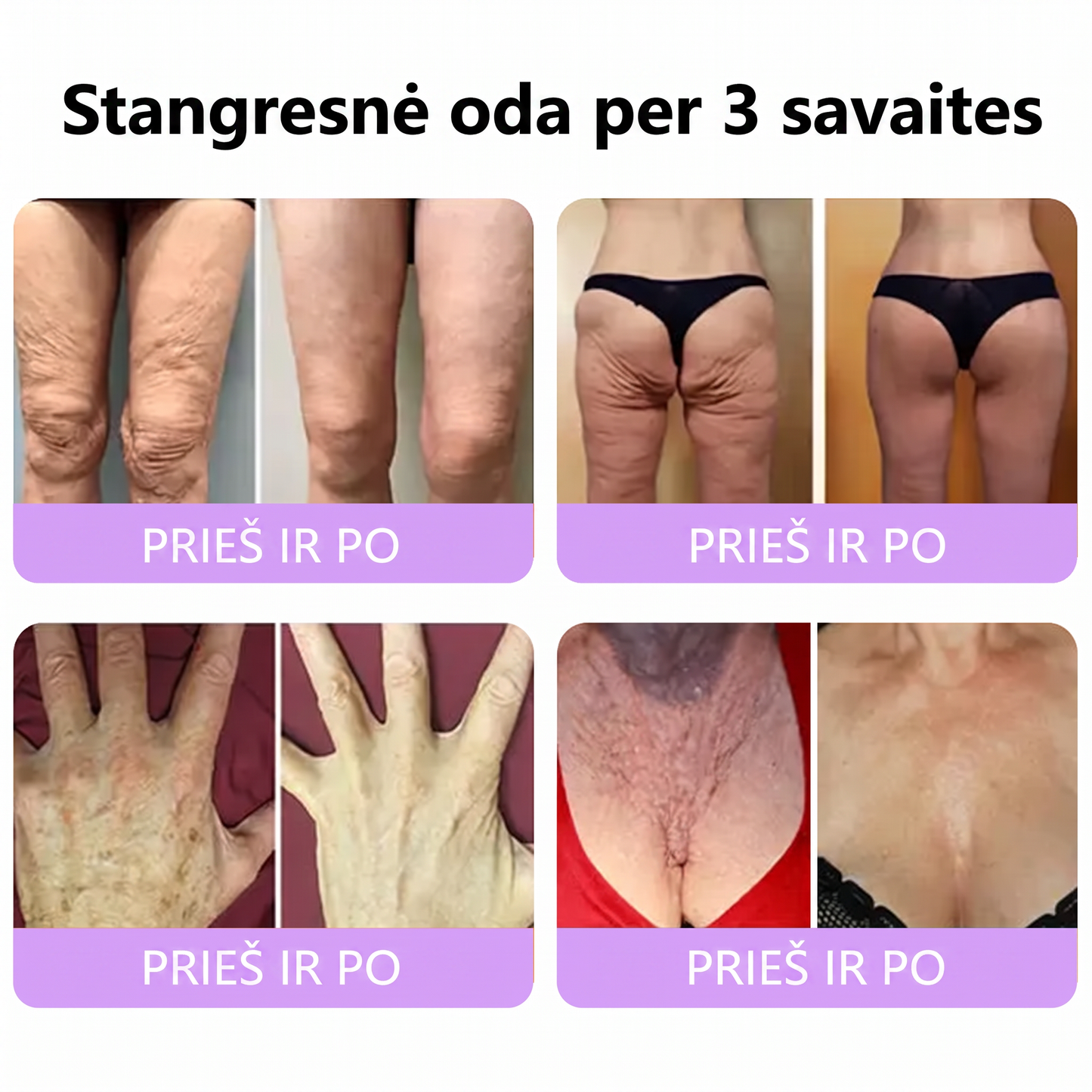 🇱🇹 Dermatologų rekomenduojama🥇 | 🍎Vitalisys® PDRN“daugiapeptidis masažuojamasis kūno kremas – Anti-senėjimo, drėkinamasis,stangrinamasis,odą regeneruojantis,sulyginantis,spuogų ir dėmių šalinimo,karpų ir apgamų šalinimo, psoriazės palengvinimo priemonė.❤️