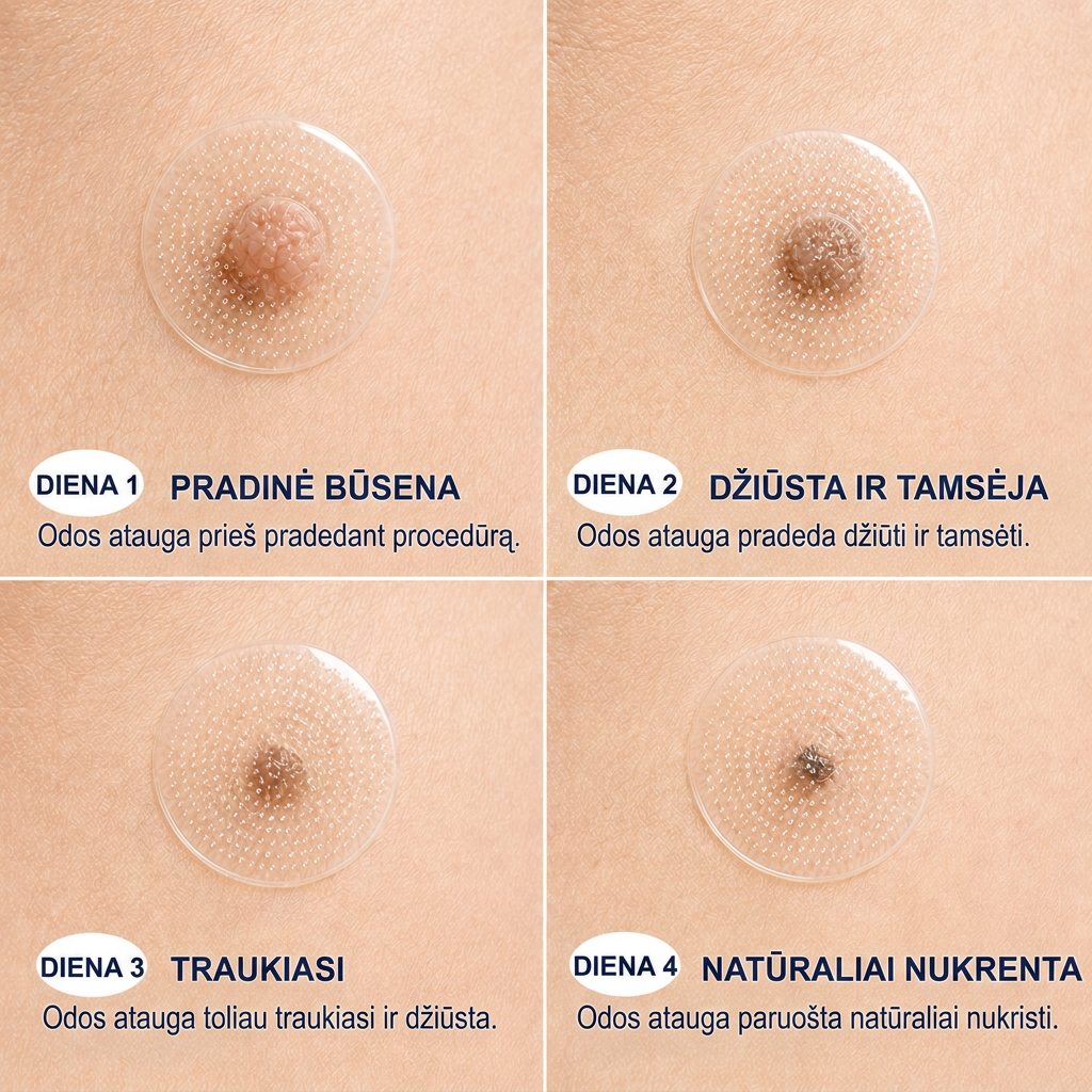 👩‍⚕️💯 Oficiální obchod | MURWON® 🌥️ Mikrojehličková náplast pro odstranění kožních nedokonalostí (Pro kožní výrůstky, drobné kožní útvary, bradavice, mateřská znaménka, stařecké skvrny a pigmentové nepravidelnosti.)❤️