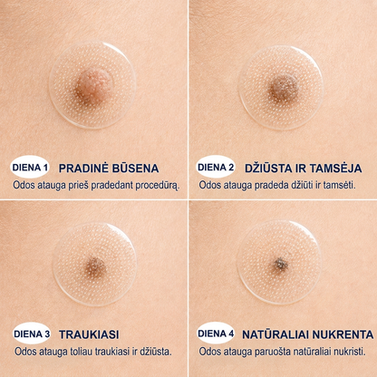 👩‍⚕️💯 Oficiální obchod | MURWON® 🌥️ Mikrojehličková náplast pro odstranění kožních nedokonalostí (Pro kožní výrůstky, drobné kožní útvary, bradavice, mateřská znaménka, stařecké skvrny a pigmentové nepravidelnosti.)❤️