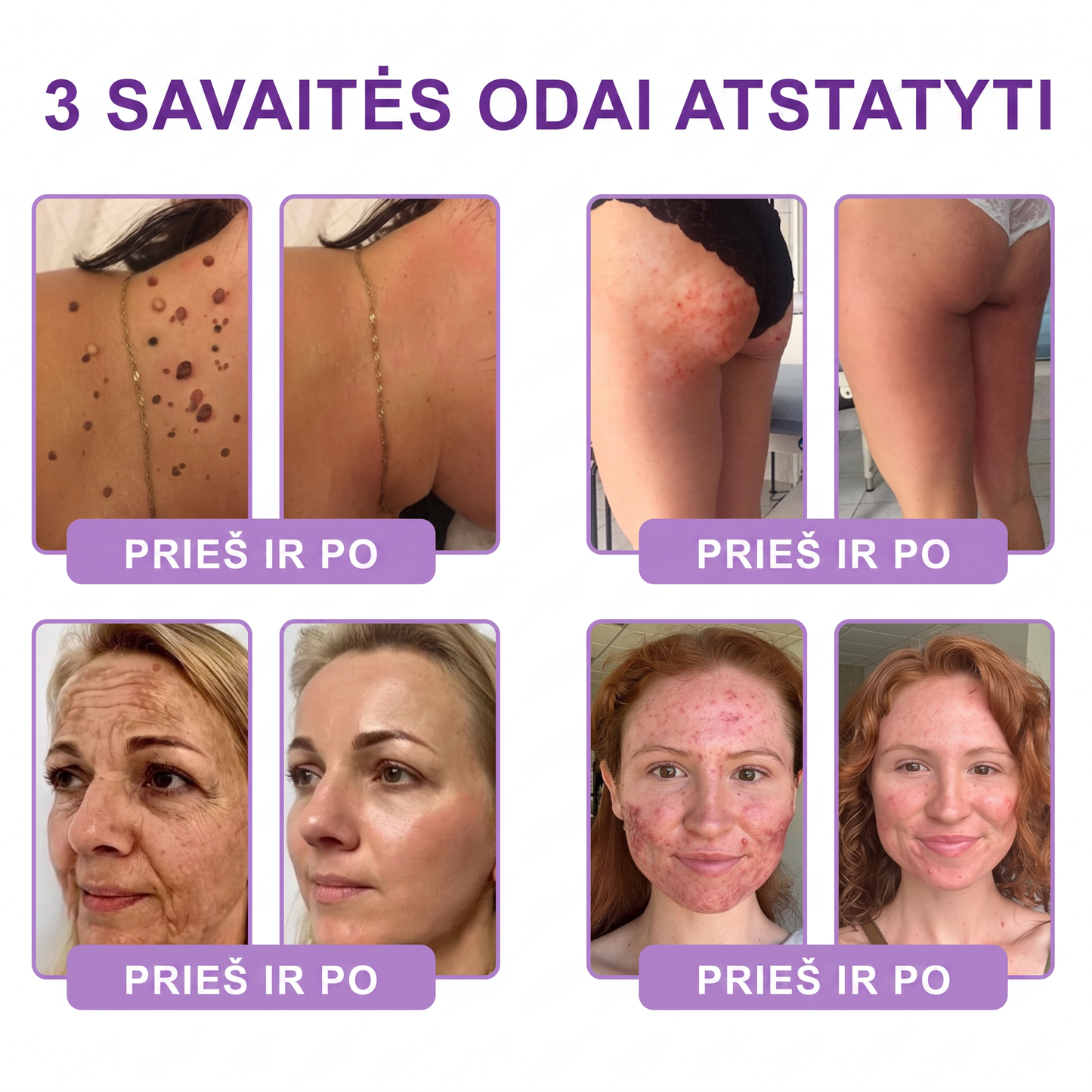 🇱🇹 Dermatologų rekomenduojama🥇 | 🍎Vitalisys® PDRN“daugiapeptidis masažuojamasis kūno kremas – Anti-senėjimo, drėkinamasis,stangrinamasis,odą regeneruojantis,sulyginantis,spuogų ir dėmių šalinimo,karpų ir apgamų šalinimo, psoriazės palengvinimo priemonė.❤️