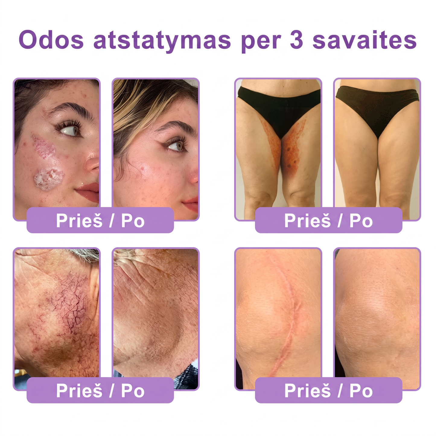 🇱🇹 Dermatologų rekomenduojama🥇 | 🍎Vitalisys® PDRN“daugiapeptidis masažuojamasis kūno kremas – Anti-senėjimo, drėkinamasis,stangrinamasis,odą regeneruojantis,sulyginantis,spuogų ir dėmių šalinimo,karpų ir apgamų šalinimo, psoriazės palengvinimo priemonė.❤️