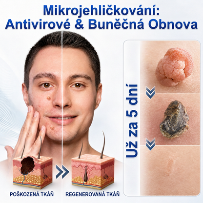 👩‍⚕️💯 Oficiální obchod | MURWON® 🌥️ Mikrojehličková náplast pro odstranění kožních nedokonalostí (Pro kožní výrůstky, drobné kožní útvary, bradavice, mateřská znaménka, stařecké skvrny a pigmentové nepravidelnosti.)❤️