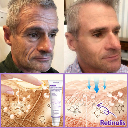 🇱🇹 Dermatologų rekomenduojama🥇 | 🍎Vitalisys® PDRN“daugiapeptidis masažuojamasis kūno kremas – Anti-senėjimo, drėkinamasis,stangrinamasis,odą regeneruojantis,sulyginantis,spuogų ir dėmių šalinimo,karpų ir apgamų šalinimo, psoriazės palengvinimo priemonė.❤️